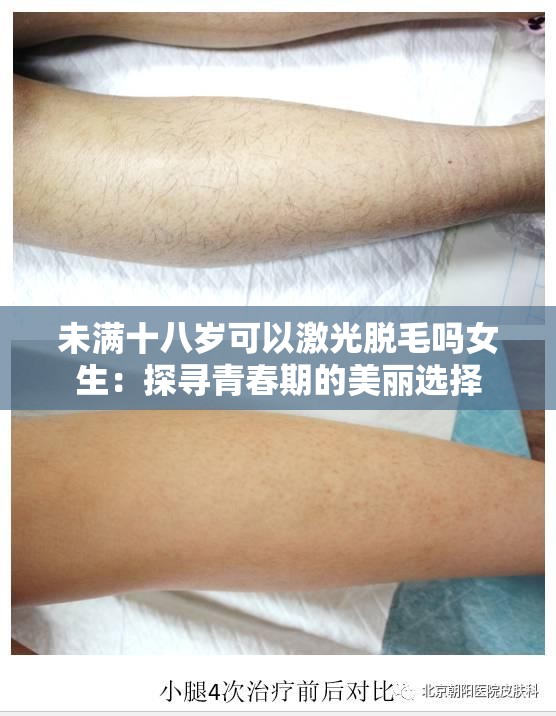 未满十八岁可以激光脱毛吗女生：探寻青春期的美丽选择